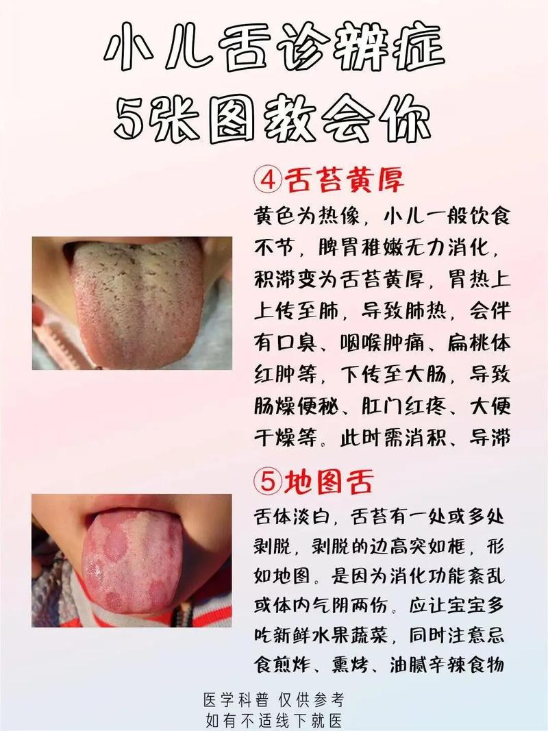 新生儿舌苔厚白发黄是正常现象吗？需要干预吗？-第2张图片-郑州医学网