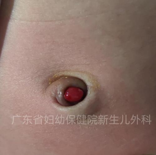 新生儿CH异常严重吗？早发现早干预对宝宝影响有多大？-第1张图片-郑州医学网