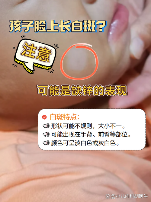 儿童脸上有白斑是缺微量元素还是其他健康问题？-第3张图片-郑州医学网