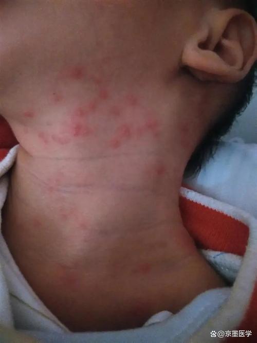 新生儿脖子红疙瘩带白点是湿疹还是感染？该如何正确护理？-第2张图片-郑州医学网