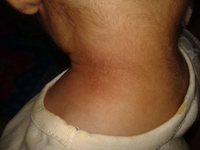 新生儿脖子红疙瘩带白点是湿疹还是感染？该如何正确护理？-第3张图片-郑州医学网