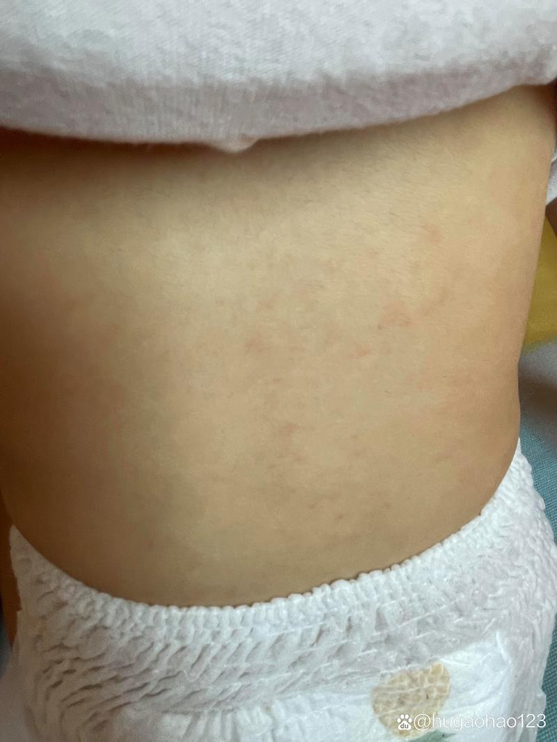 儿童出疹子有哪些常见症状？不同皮疹图片如何区分？-第1张图片-郑州医学网