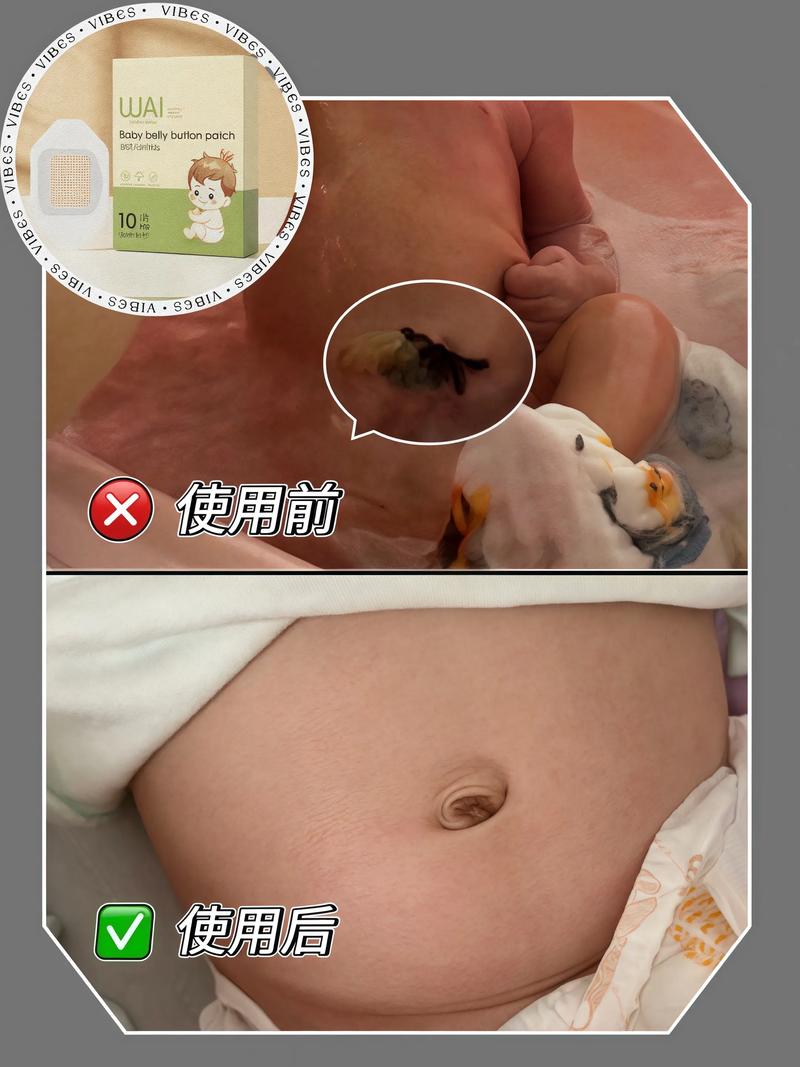 新生儿脐带贴怎么使用-第2张图片-郑州医学网