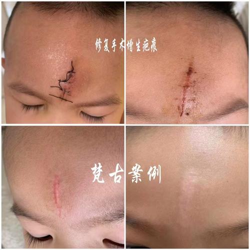 儿童烧伤疤痕修复有哪些科学方法？不同年龄段修复效果差异大吗？-第1张图片-郑州医学网