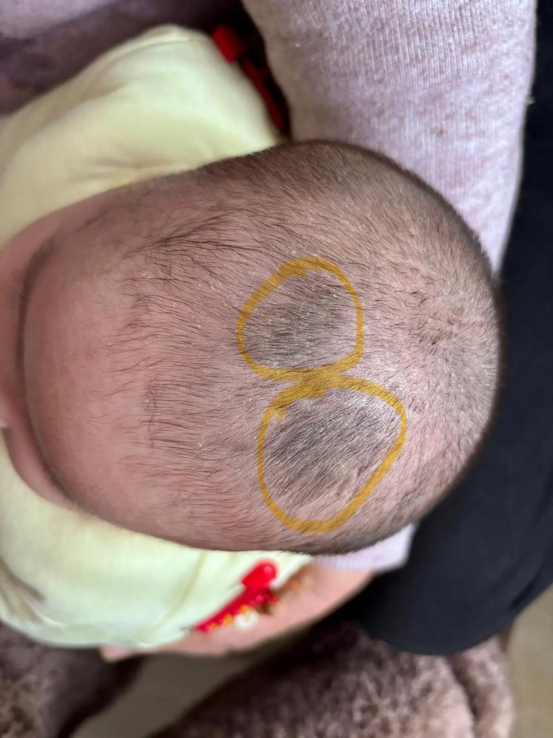 新生儿囟门上没头发是缺钙还是发育异常？需要担心吗？-第1张图片-郑州医学网