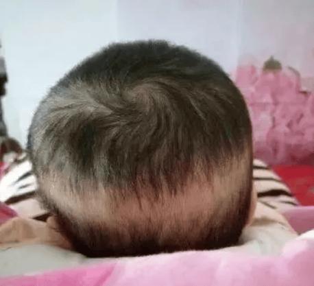 新生儿囟门上没头发是缺钙还是发育异常？需要担心吗？-第2张图片-郑州医学网