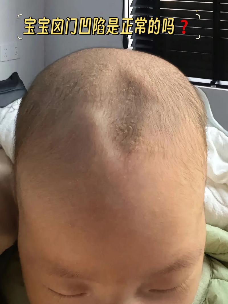 新生儿囟门上没头发是缺钙还是发育异常？需要担心吗？-第3张图片-郑州医学网