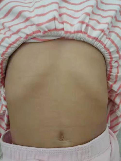 儿童轻度漏斗胸图片能直观判断病情严重程度吗？-第2张图片-郑州医学网