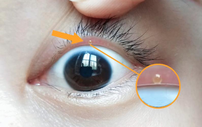 新生儿眼睛周围长水泡是正常现象还是疾病信号？需警惕哪些潜在风险？-第3张图片-郑州医学网