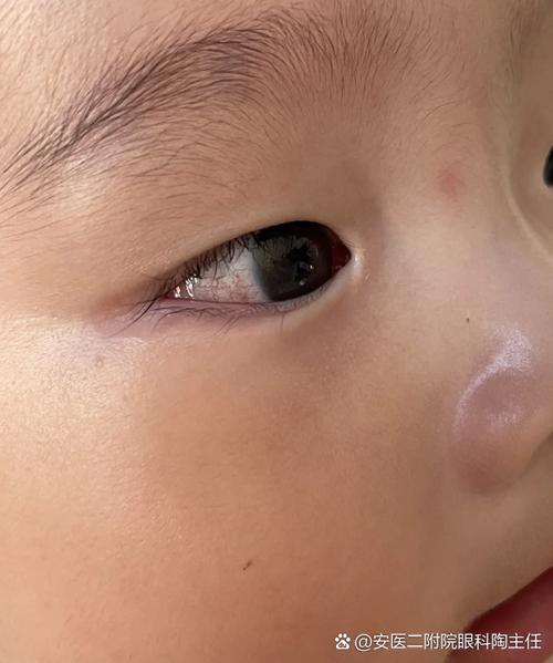 新生儿白眼球出现红点是何原因？需要警惕哪些眼部问题？-第2张图片-郑州医学网