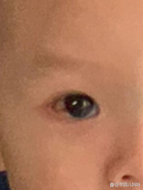 新生儿白眼球出现红点是何原因？需要警惕哪些眼部问题？-第3张图片-郑州医学网