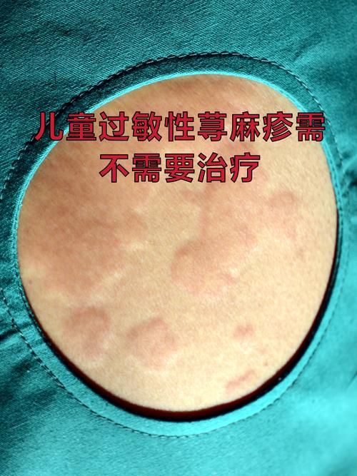 儿童寻麻疹症状和治疗有哪些关键点？家长如何应对才能有效缓解？-第2张图片-郑州医学网