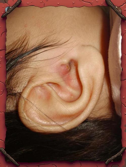 儿童耳朵外耳廓红肿痒-第1张图片-郑州医学网