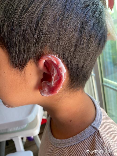 儿童耳朵外耳廓红肿痒-第3张图片-郑州医学网