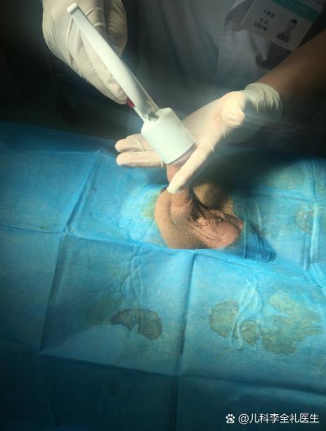 儿童环切手术后脱落过程会持续多久？脱落期间需要如何护理？-第1张图片-郑州医学网