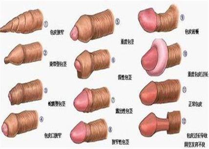 儿童环切手术后脱落过程会持续多久？脱落期间需要如何护理？-第2张图片-郑州医学网