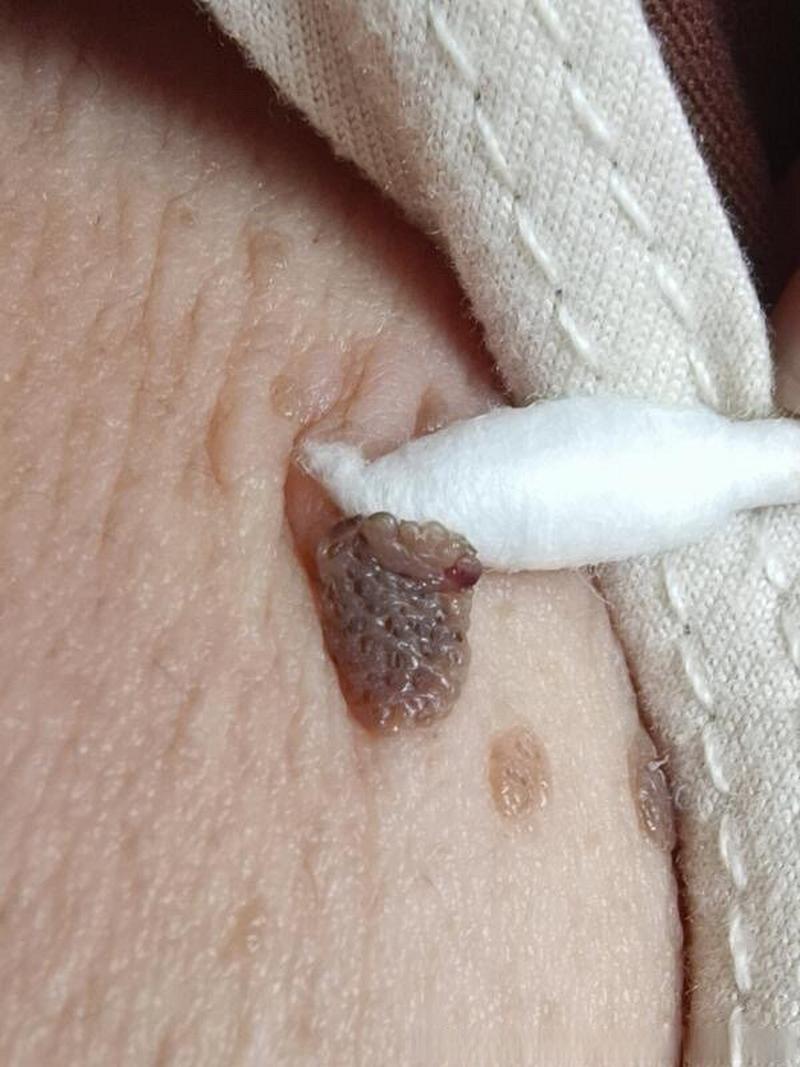 怀孕期间胸上长小肉粒-第1张图片-郑州医学网