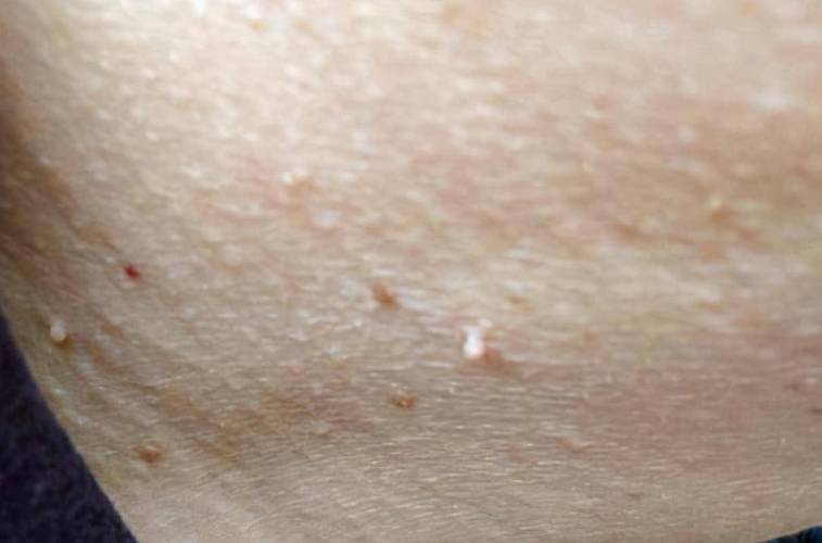 怀孕期间胸上长小肉粒-第2张图片-郑州医学网