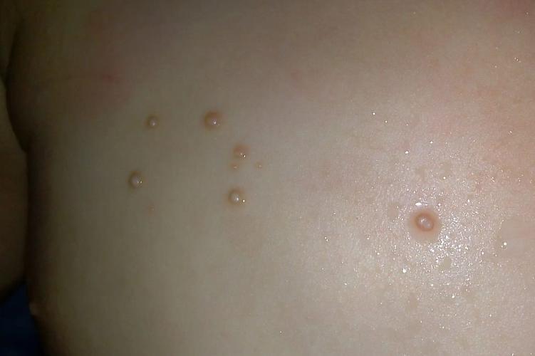 怀孕期间胸上长小肉粒-第3张图片-郑州医学网