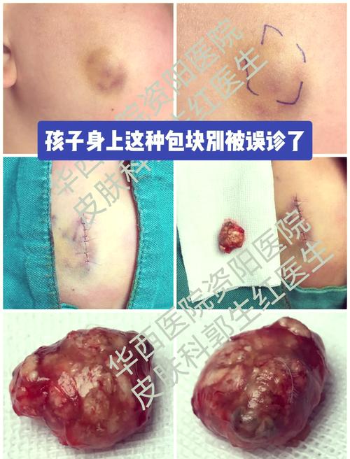 儿童钙化上皮瘤的发病原因是什么？与遗传、外伤或胚胎发育异常有关吗？-第1张图片-郑州医学网