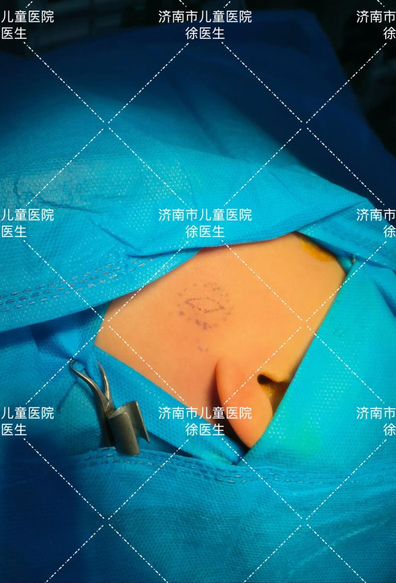 儿童钙化上皮瘤的发病原因是什么？与遗传、外伤或胚胎发育异常有关吗？-第3张图片-郑州医学网