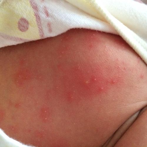 新生儿脸上红色疙瘩是湿疹还是痤疮？该如何正确护理？-第2张图片-郑州医学网