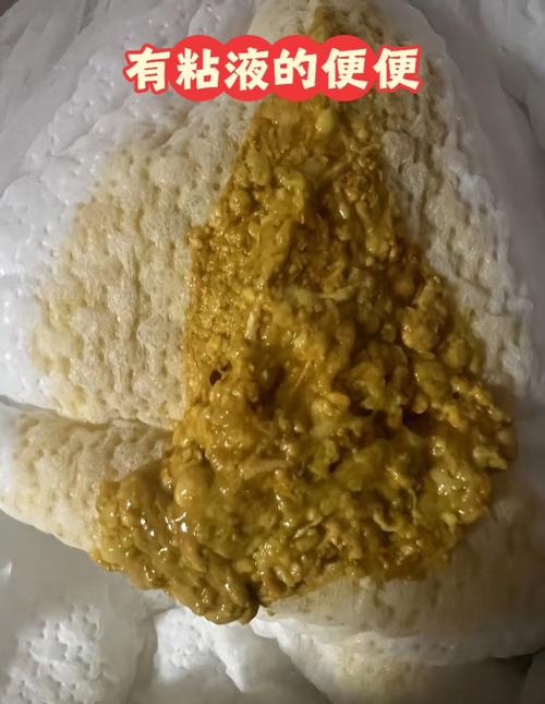 新生儿宝宝粑粑酸臭味-第1张图片-郑州医学网