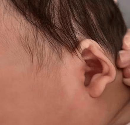 新生儿左耳没有外耳廓-第1张图片-郑州医学网