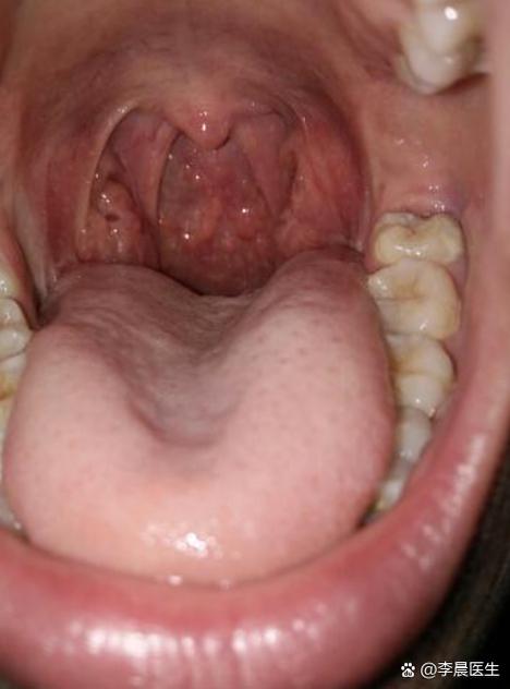 儿童喉咙滤泡增生图片是疾病表现吗？需要治疗吗？-第1张图片-郑州医学网