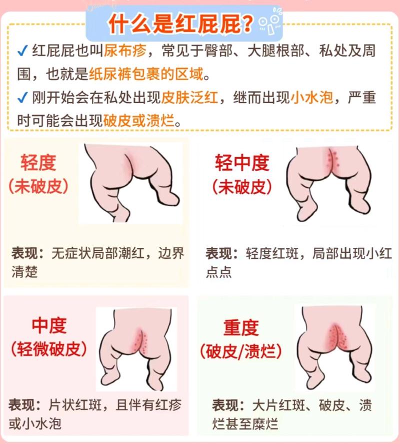 新生儿屁股湿疹反反复复，到底该怎么护理才能好得快？-第1张图片-郑州医学网