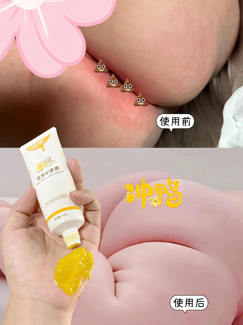 新生儿屁股湿疹反反复复，到底该怎么护理才能好得快？-第2张图片-郑州医学网
