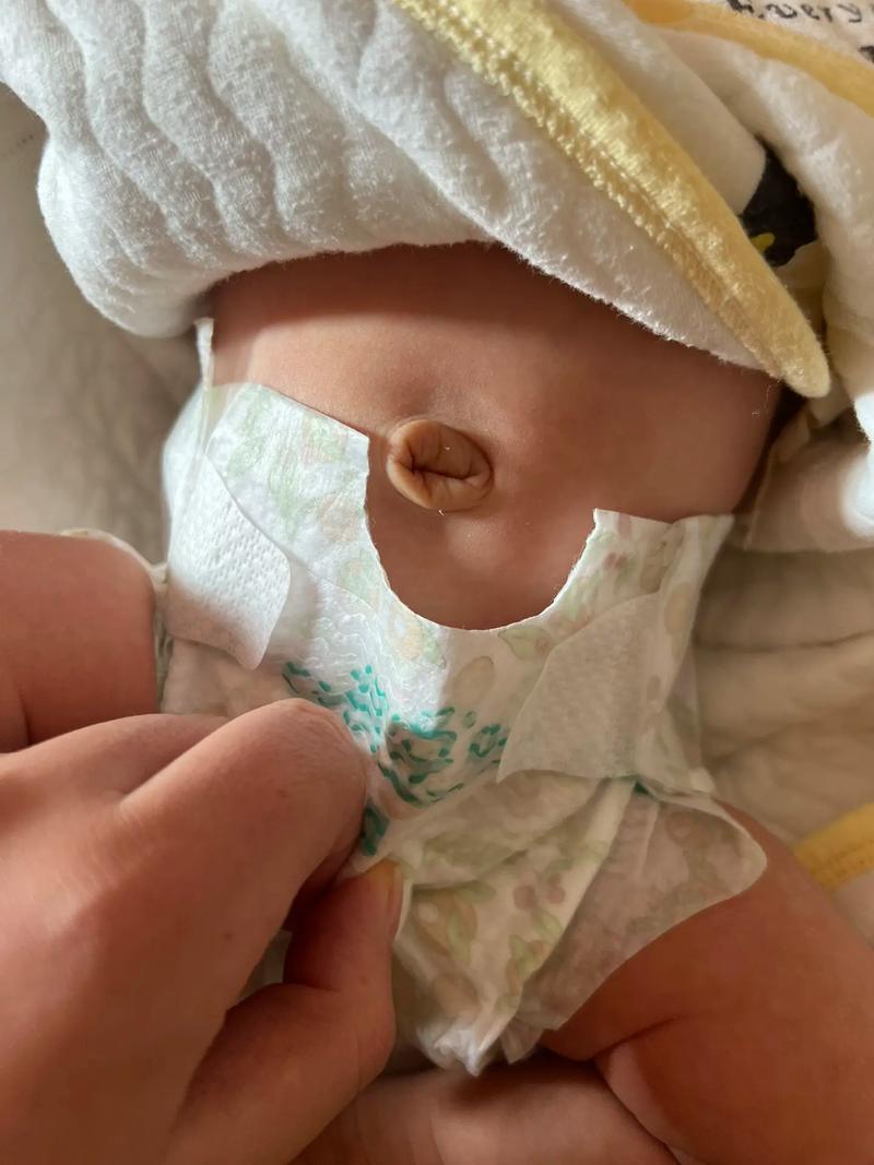 新生儿肚脐根部未脱落，家长该如何正确护理与观察呢？-第3张图片-郑州医学网