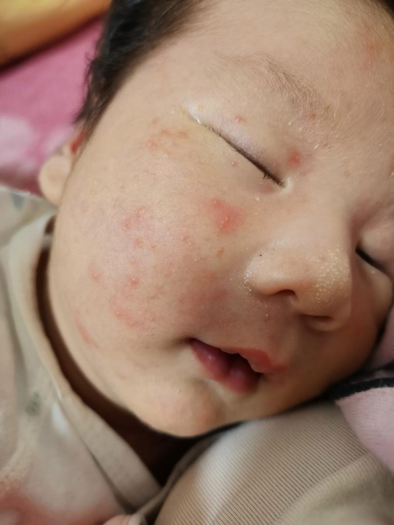 新生儿出生脸上长痘痘是正常现象吗？需要治疗吗？-第2张图片-郑州医学网