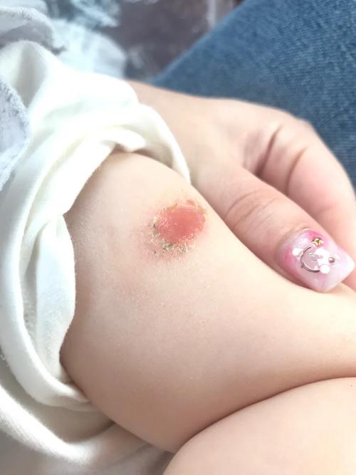 新生儿打疫苗后起脓包是正常反应吗?需要处理吗?-第1张图片-郑州医学网 新生儿打疫苗后起脓包是正常反应吗?需要处理吗?-第1张图片-郑州医学网