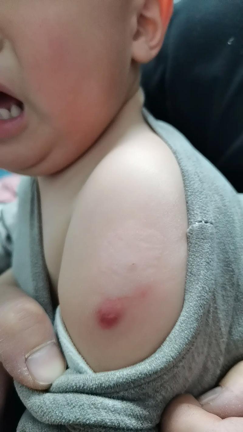 新生儿打疫苗后起脓包是正常反应吗？需要处理吗？-第2张图片-郑州医学网