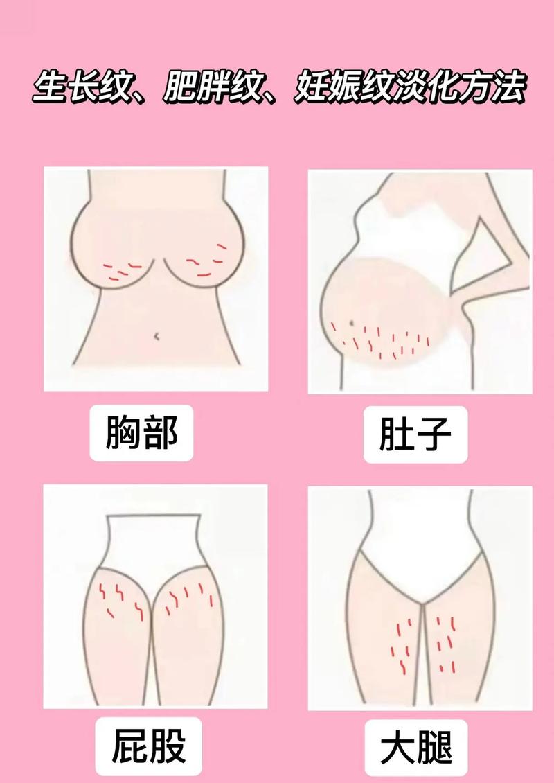 孕期胸痒是长妊娠纹的前兆吗?该如何区分与正确护理?-第1张图片-郑州医学网 孕期胸痒是长妊娠纹的前兆吗?该如何区分与正确护理?-第1张图片-郑州医学网