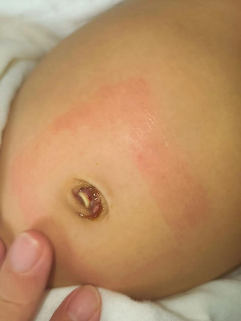 新生儿肚皮血管明显是正常现象吗？需要担心哪些健康问题？-第3张图片-郑州医学网