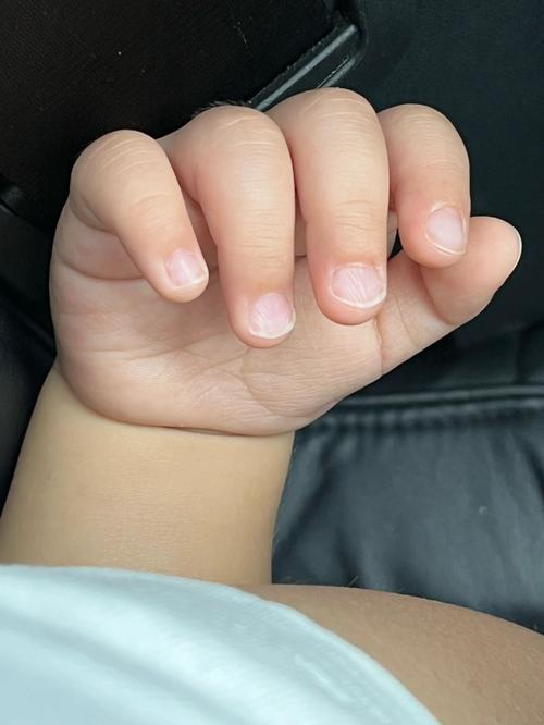 新生儿手发白没血色是正常现象还是疾病信号？需警惕哪些潜在问题？-第3张图片-郑州医学网