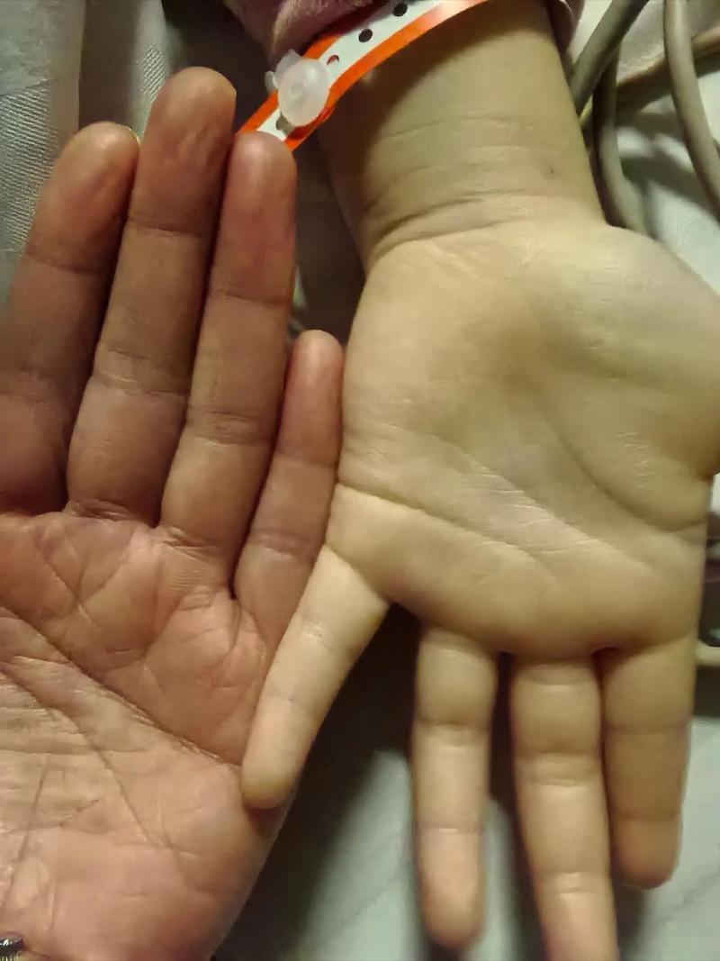 新生儿手发白没血色是正常现象还是疾病信号？需警惕哪些潜在问题？-第1张图片-郑州医学网