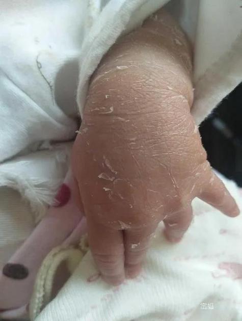 新生儿手发白没血色是正常现象还是疾病信号？需警惕哪些潜在问题？-第2张图片-郑州医学网