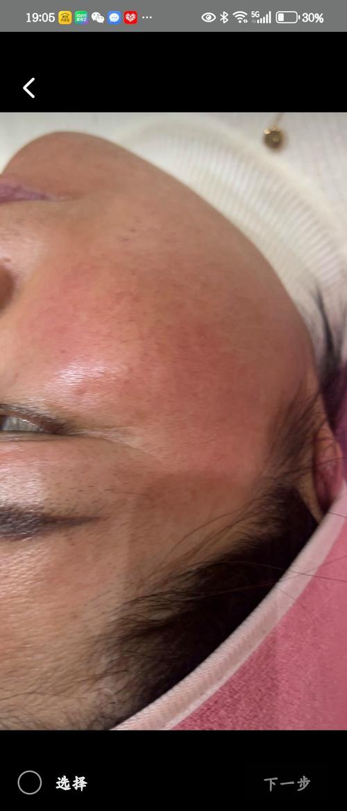 怀孕期间皮肤出现红血丝,是激素变化还是皮肤屏障受损了?-第1张图片-郑州医学网 怀孕期间皮肤出现红血丝,是激素变化还是皮肤屏障受损了?-第1张图片-郑州医学网