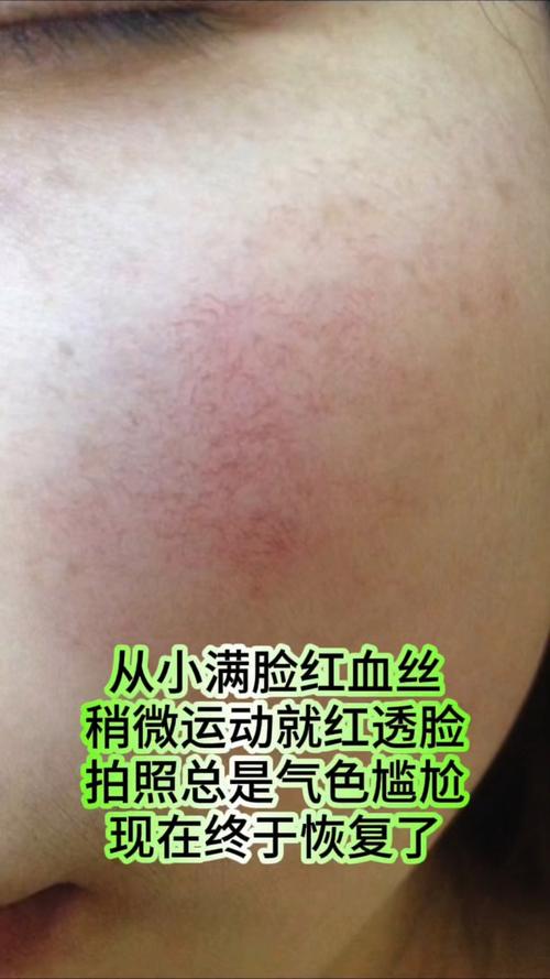 怀孕期间皮肤出现红血丝,是激素变化还是皮肤屏障受损了?-第2张图片-郑州医学网 怀孕期间皮肤出现红血丝,是激素变化还是皮肤屏障受损了?-第2张图片-郑州医学网