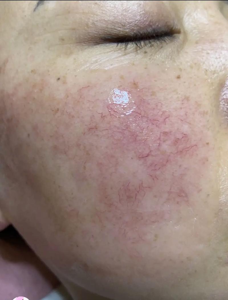 怀孕期间皮肤出现红血丝,是激素变化还是皮肤屏障受损了?-第3张图片-郑州医学网 怀孕期间皮肤出现红血丝,是激素变化还是皮肤屏障受损了?-第3张图片-郑州医学网