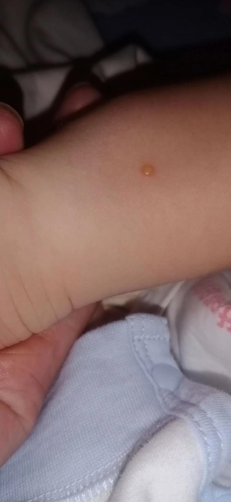 儿童身上起透明小水泡是湿疹还是手足口病？该如何正确处理？-第1张图片-郑州医学网