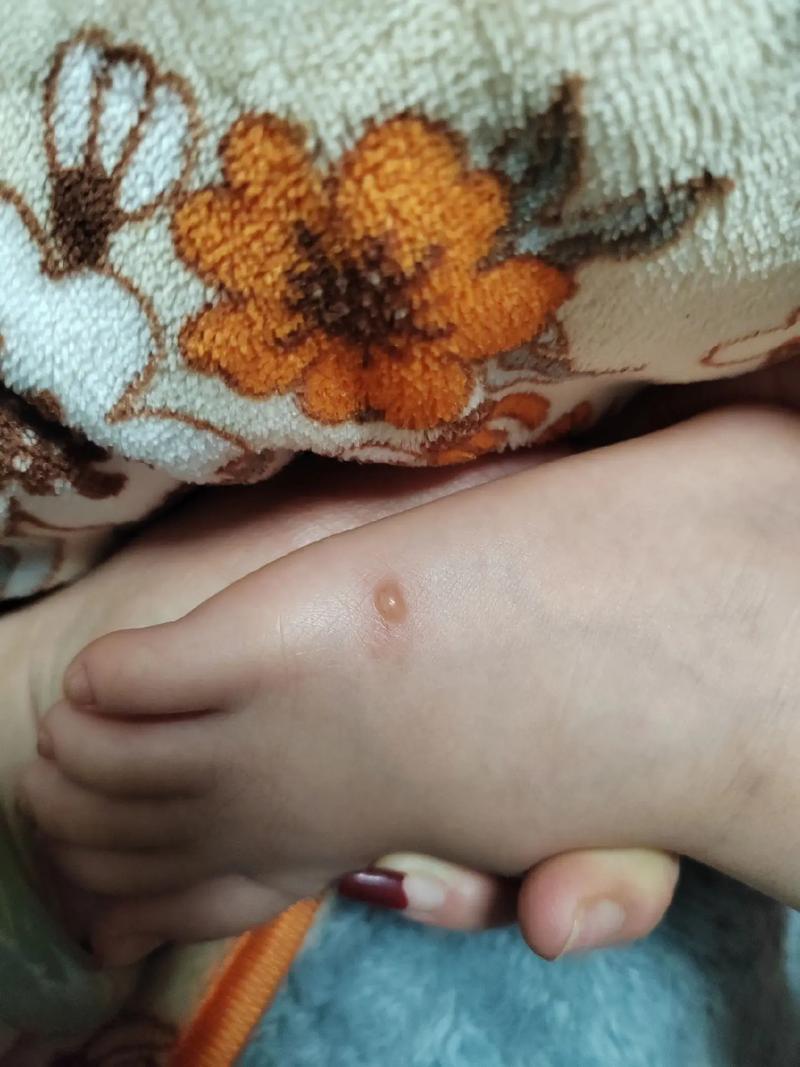 儿童身上起透明小水泡是湿疹还是手足口病？该如何正确处理？-第2张图片-郑州医学网