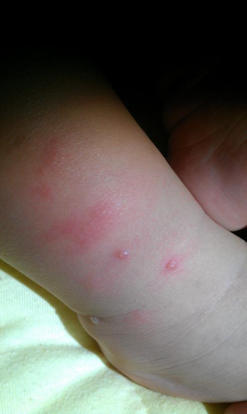 儿童身上起透明小水泡是湿疹还是手足口病？该如何正确处理？-第3张图片-郑州医学网