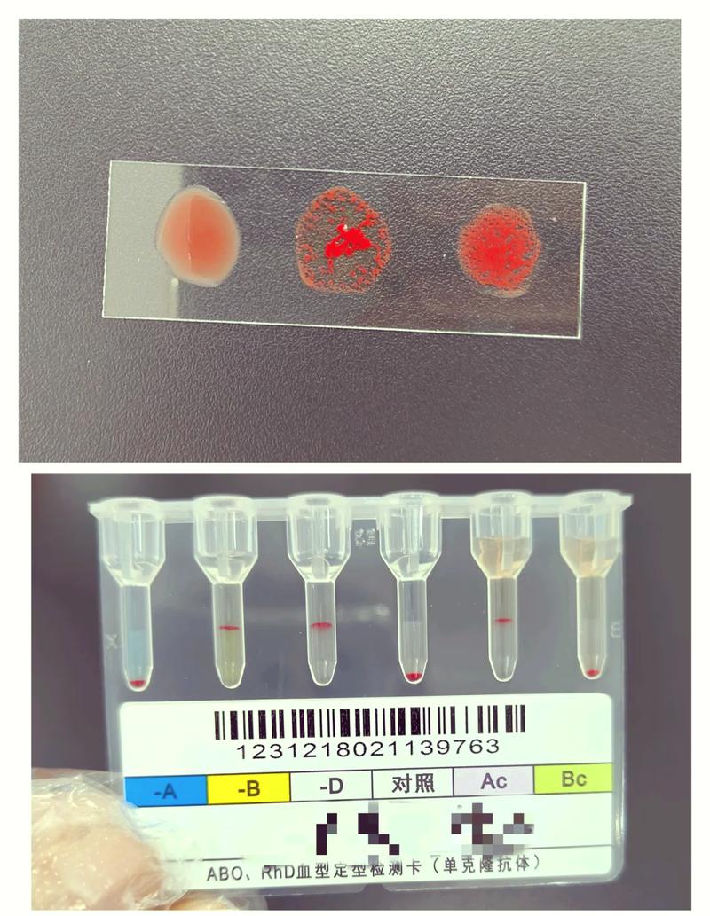 新生儿血液培养阳性意味着什么？该如何应对和后续治疗？-第2张图片-郑州医学网