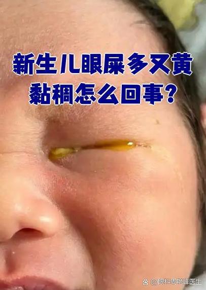 新生儿眼睛多黄眼屎是上火还是疾病信号？该如何正确处理？-第1张图片-郑州医学网