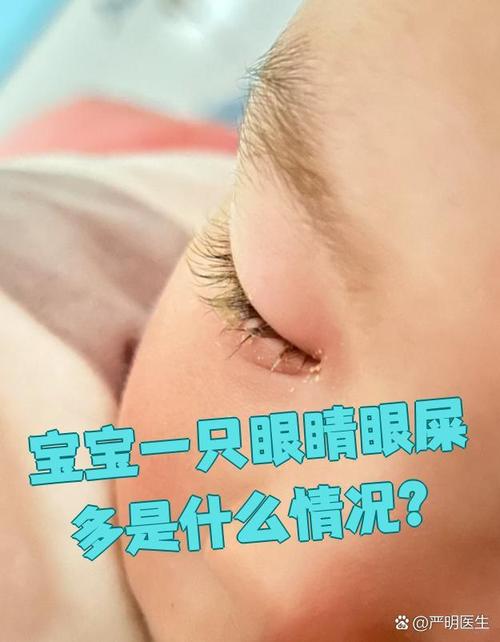 新生儿眼睛多黄眼屎是上火还是疾病信号？该如何正确处理？-第2张图片-郑州医学网