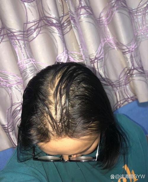 孕期脱发后，头发真的能重新长出来吗？需要多久才能恢复呢？-第2张图片-郑州医学网